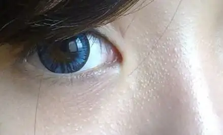 2014-08-20 10:16 乖猫猫儿2013|四级 你好,这不是粉刺,这是小脂肪粒