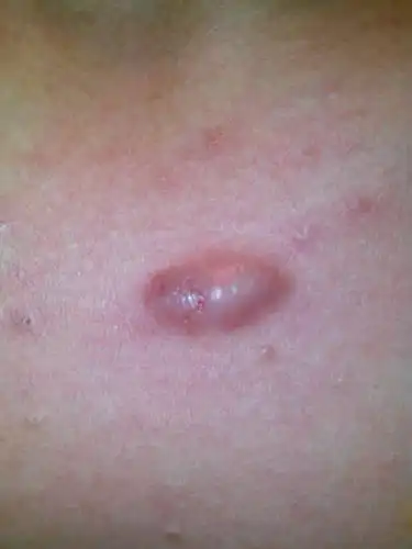 这颗痘痘长了一年多了,里面好像长了一块硬邦邦的东西,有时候会痒,我