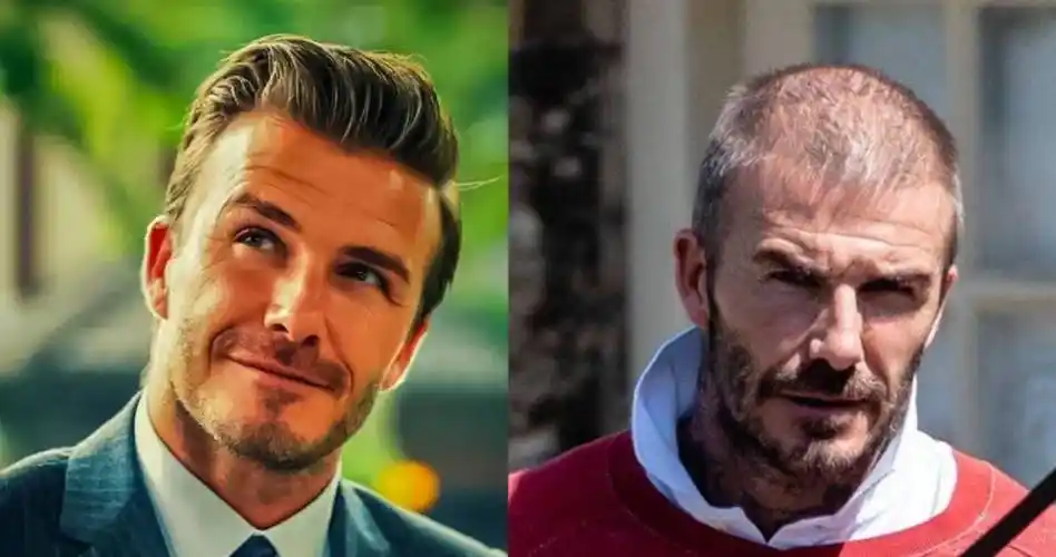 帅气也挡不住脱发的10位男明星!你知道还有谁?_贝克汉姆_头发_前额