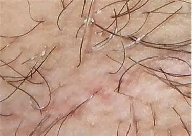 如何预防腋毛癣?不妨了解了解