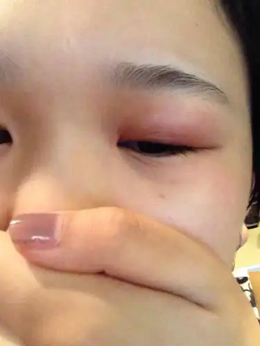 问:左眼睛已经肿了两天了 没有被虫子咬 也没有麦粒肿 早晨一起床就成