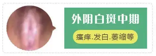 11-26 09:37 订阅 医学研究显示 外阴白斑是一种细胞发生病损引起的