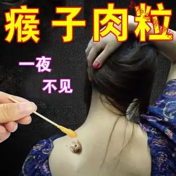 祛瘊绅器瘊i子肉i刺扁平尤无痛祛脖子小肉粒丝状尤黑痣特孝液体验装