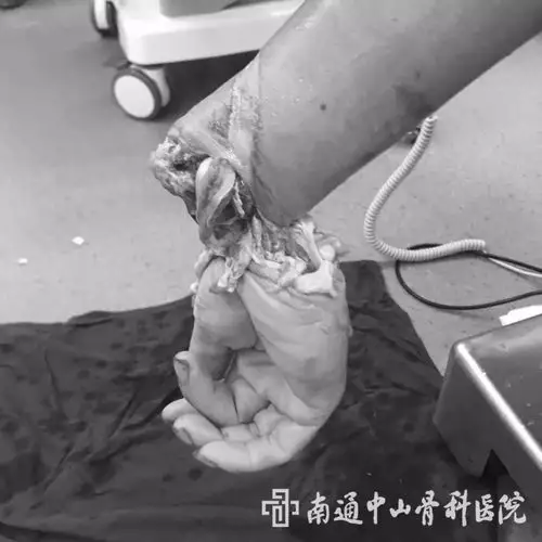 【案例】工作疏忽致右腕部离断 中山医生妙手成功再植_断肢