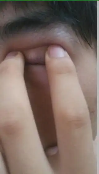 眼睛上长了一个大包