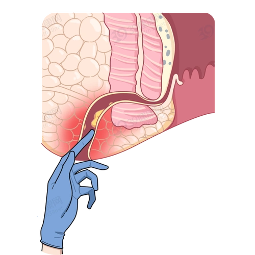 裤子脱了腿张开医院让人脸红的肛门指检竟能查出这么多病