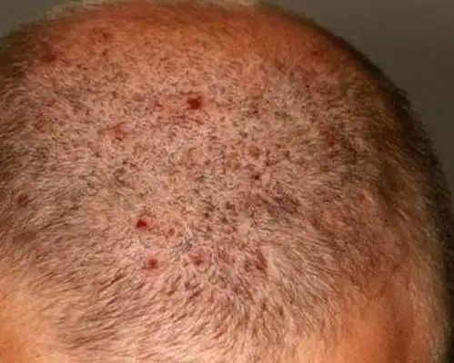 头皮癣图片 (52)