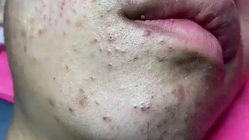 48超解压视频,挤痘痘粉刺黑头,大丰收哦