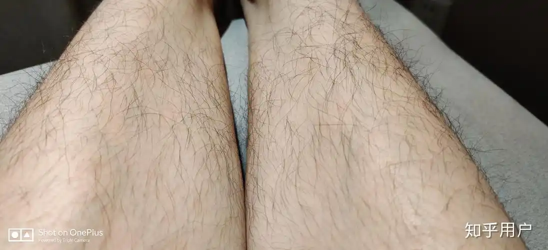 腿毛真的会越刮越多吗