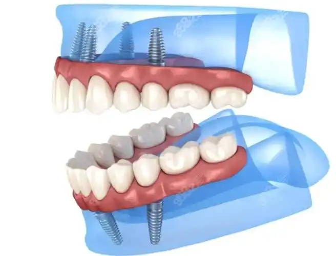 种植牙选半固定和全固定的区别可不止是费用和使用寿命