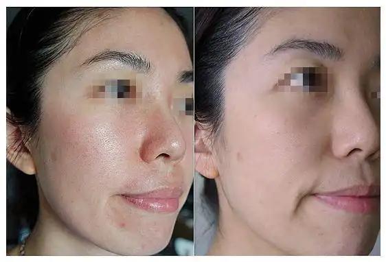 汗蒸可以收缩毛孔吗好处坏处有哪些