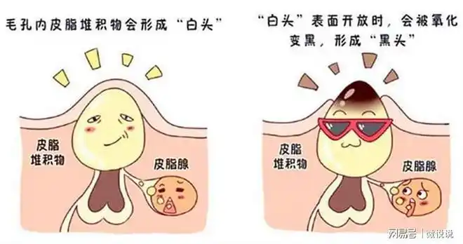 皮脂混合毛囊口尚未代谢的老废角质,形成一个柱状堵塞物堵住了毛孔口