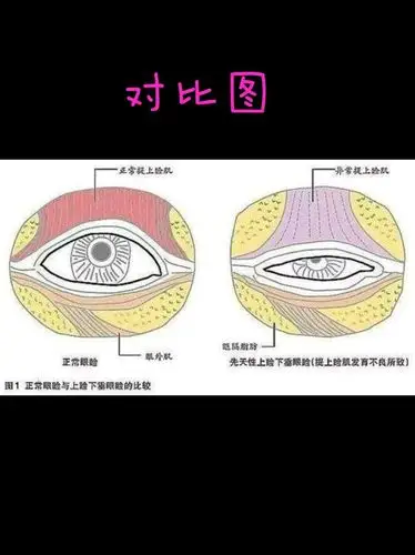 美眼女神都做了上眼睑提肌哟!