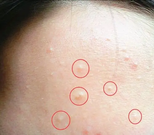 闭口是皮肤上那些肉眼看起来不明显,很多时候需要靠摸或者某个光线