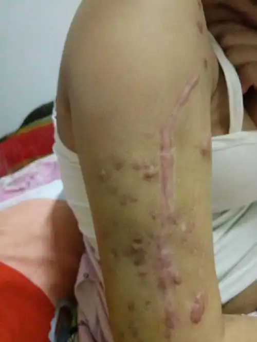 男童误将霰弹枪当玩具枪 女孩身中近百子弹部分难取出