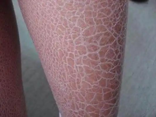 鱼鳞皮肤病 (20)