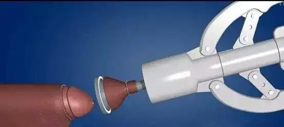 术后护理:术后3天拆除包扎纱布,待拆除包扎纱布后,使用消毒液,切口