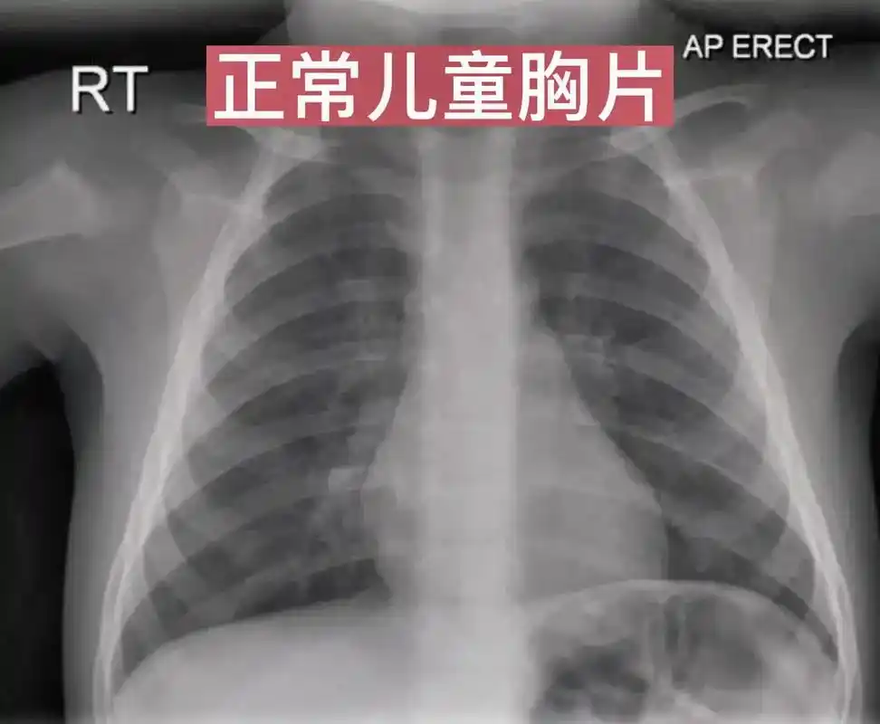 照胸片是检查什么 - 抖音