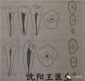 下:上颌第二前磨牙上:上颌第一前磨牙上颌前磨牙髓腔解剖和开髓部位