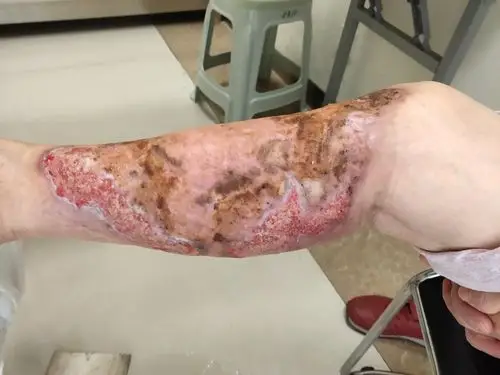 11.14陆瑞红右下肢皮肤溃疡第一次门诊换药记