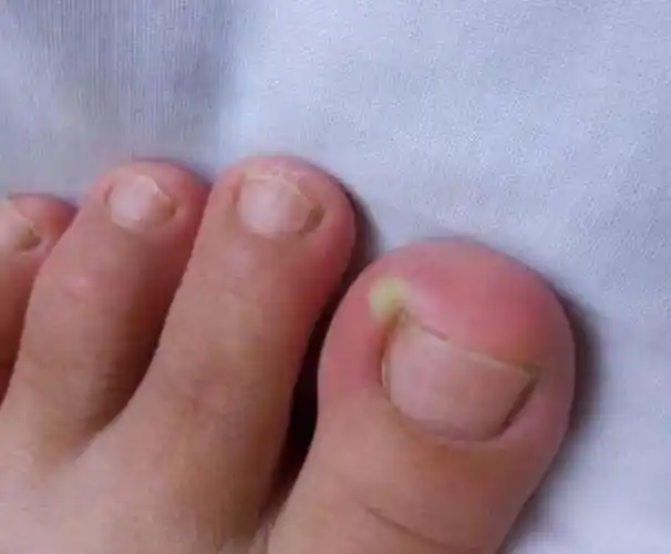 对于慢性甲沟炎,尤其是真菌感染者,保持足部干燥,穿宽松透气的鞋子如