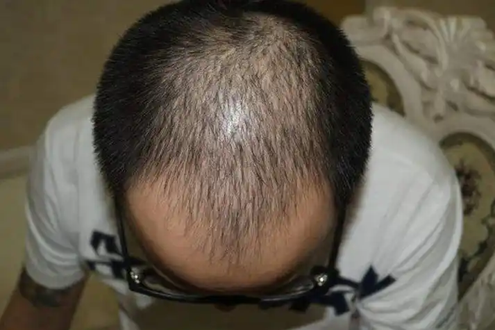 脂溢性脱发早期图片