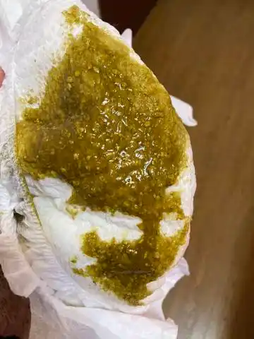 三个月的宝宝,一直拉大便很多奶瓣,该怎么改善呢?