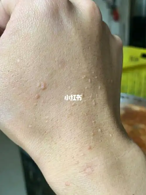 给扁平疣患者的几点建议你不能不知道