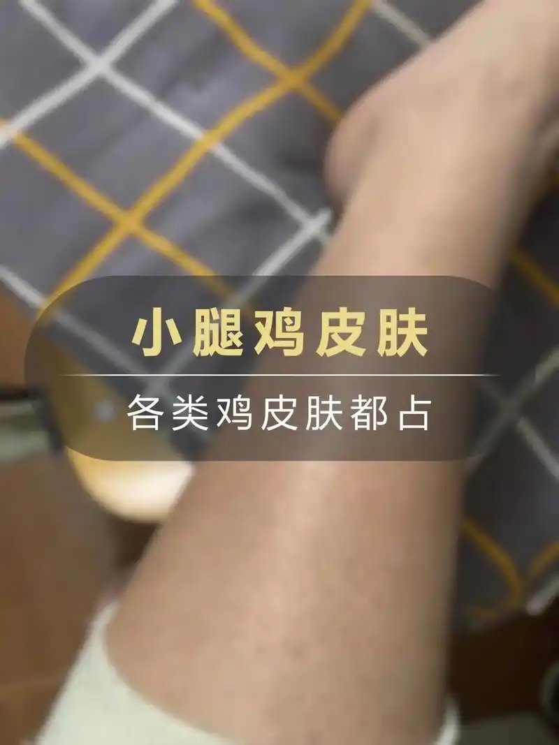 鸡皮肤改善合集(13)各类鸡皮肤都占点腿部:毛孔堵塞/引起 - 抖音