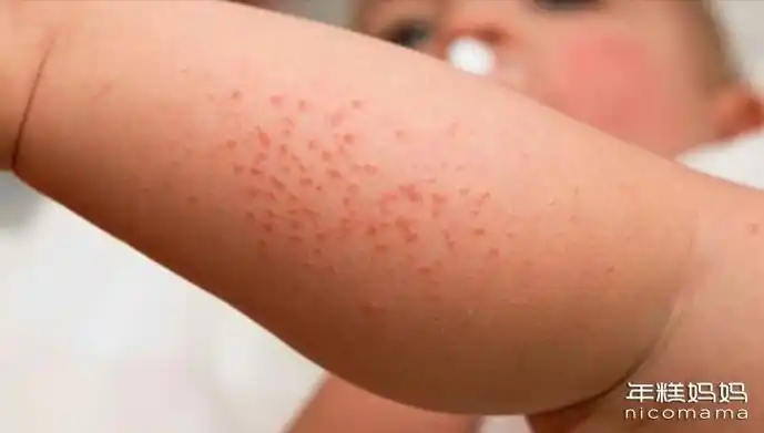 同时会红,会痒.正确的名字应该叫"异位性皮肤炎",是一种免疫失调疾病.