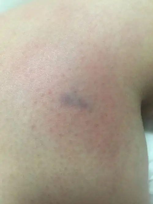 大腿内侧拍出淤青中医理论是什么情况?