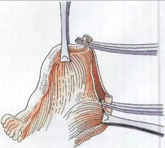 孕育指南输卵管结扎复通术找回你的二次生机