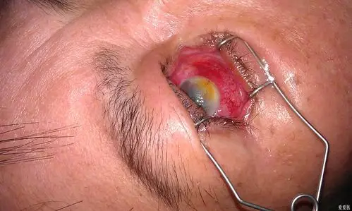 角膜溃疡来看看