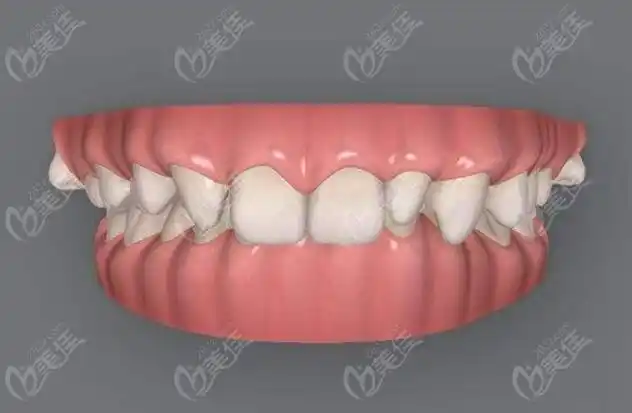 闭锁性深覆合牙齿图