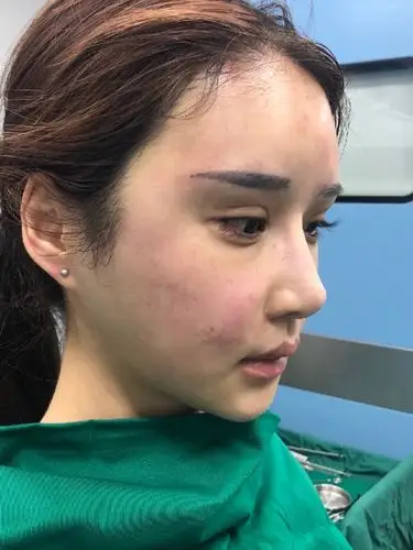 一直想做面部脂肪填充,但害怕填的多了变成寿星额头 _圈子-新氧美容