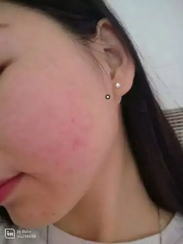 想去红血丝却变成红血丝性激素脸怎么办