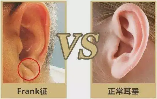 高以翔去世耳垂上有道折痕就是猝死的征兆