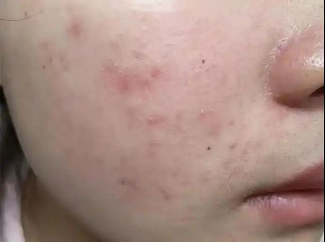 特殊的人会对红霉素产生过敏的现象,这类人就不建议使用红霉素软膏