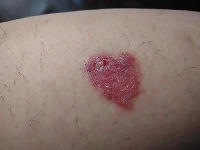 小腿上起了一个红斑