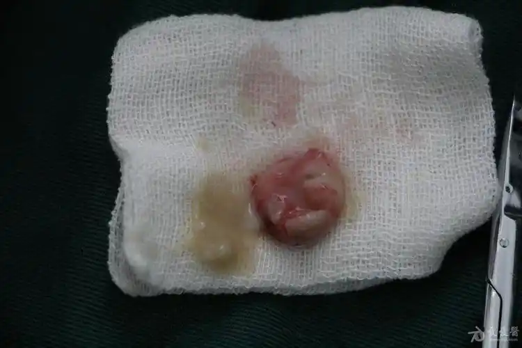 皮脂腺囊肿手术一例