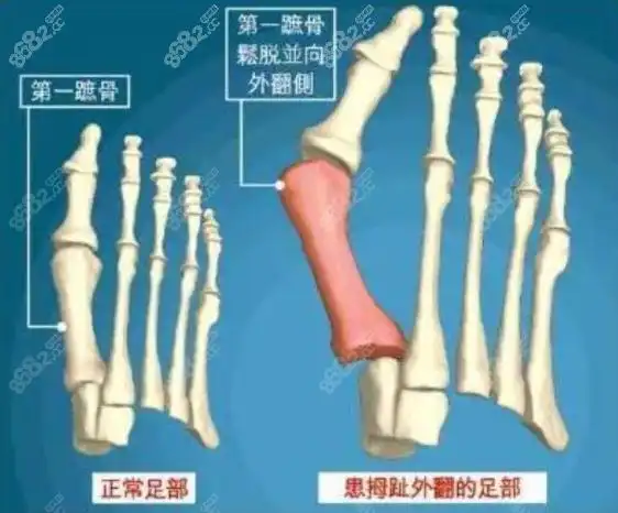 北京正规大脚骨医院圣嘉新看的如何?