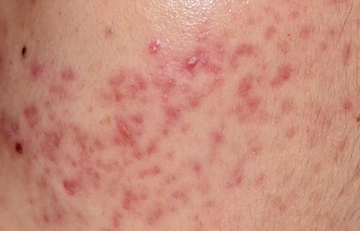 毛囊炎怎么治才能根除脸上的痘痘 #红蓝光祛痘#   毛囊炎是许多人面临