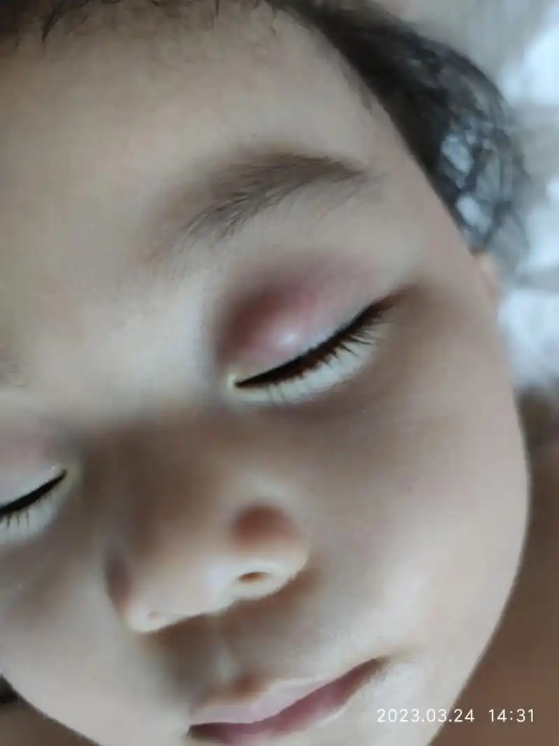 分享霰粒肿转麦粒肿过程.