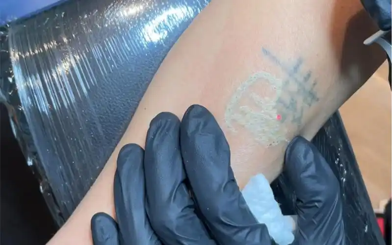 来看看皮秒洗纹身全过程昆明洗纹身