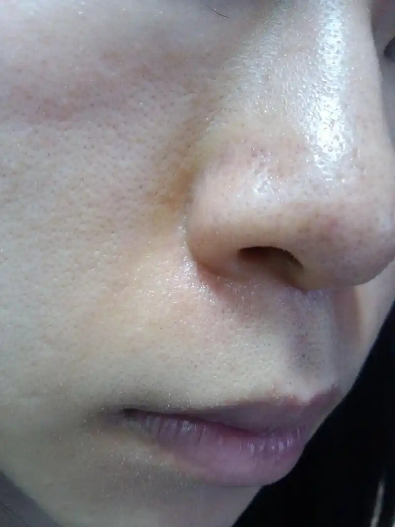 我是女生啊,黑头,白头,毛孔粗大,鼻翼发红,有什么办法治吗?