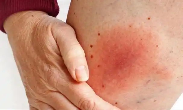 胸前的小红点到底是什么?