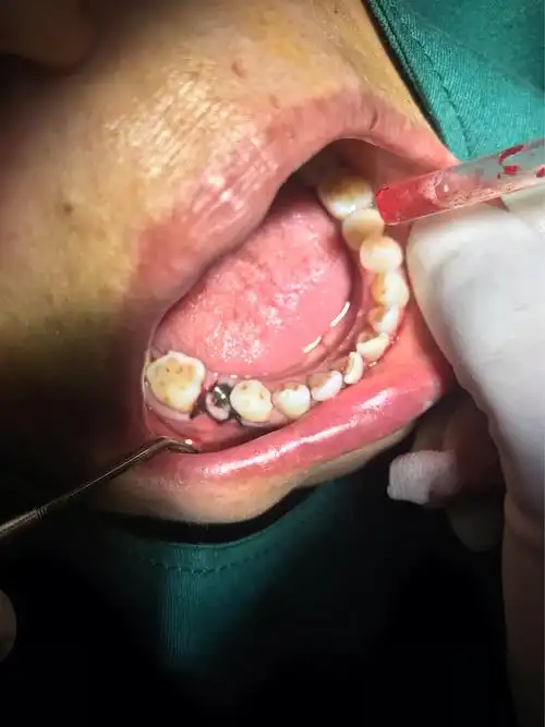 宜春市人民医院北口腔科独立完成种植手术