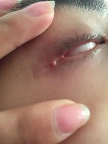 眼尾长了一个小小白色的肉体是什么东西?有问题么?看起来像脂肪粒