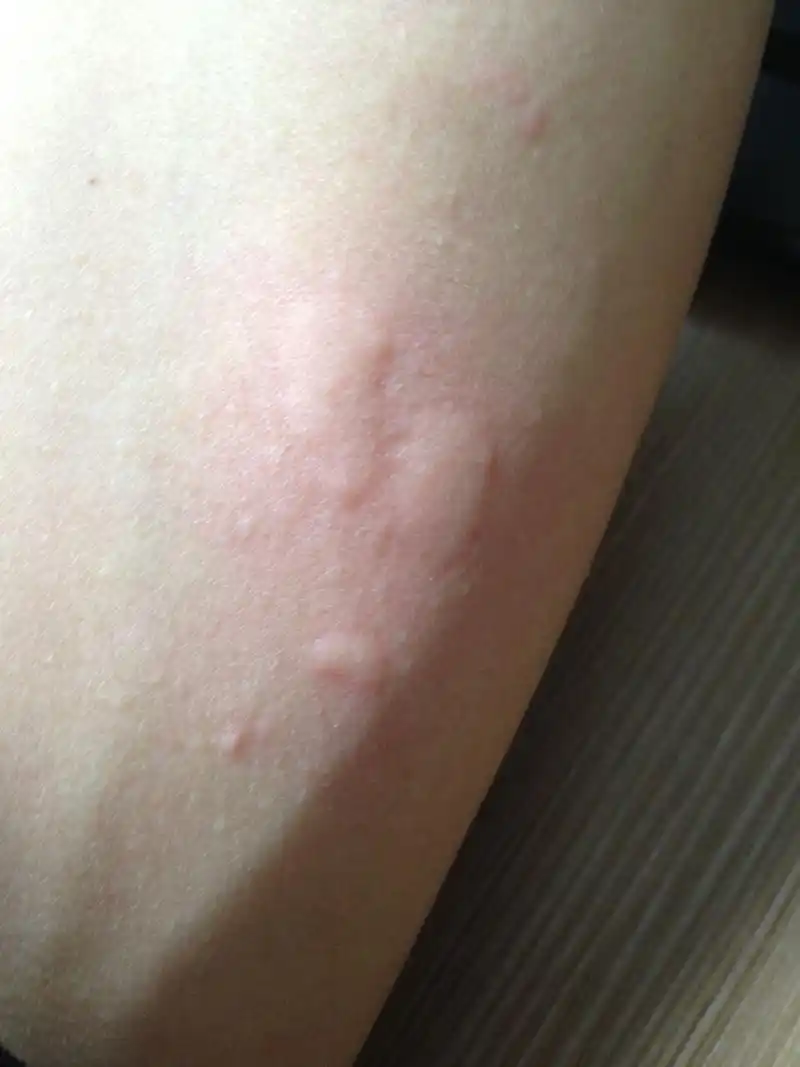 邯郸燕赵中医院皮肤科医生告诉你:皮肤瘙痒起红疙瘩,可能是这些