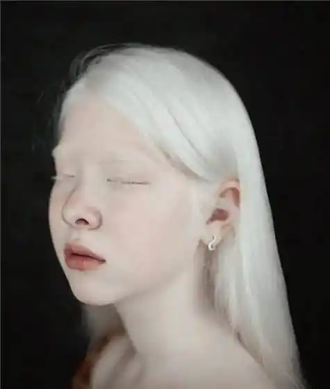 一对罕见的"白雪公主",生活中受尽歧视,拍一组照片后惊艳众人